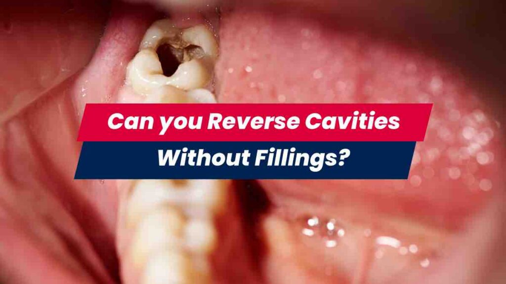 can-you-reverse-cavities-and-not-get-fillings-affordable-health