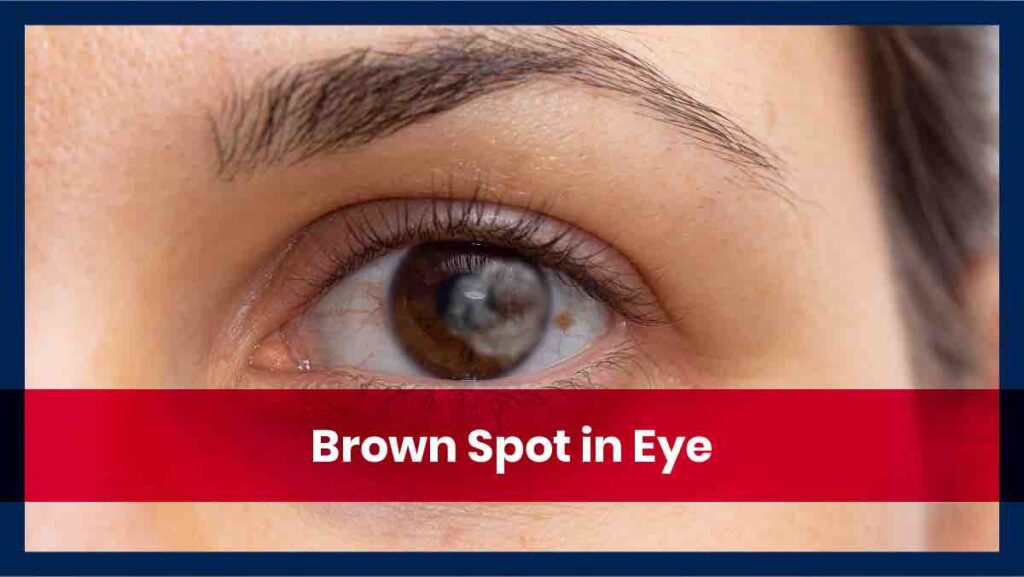 What Does Brown Spots In The Eyes Mean