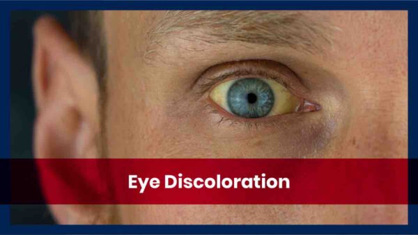 Causes and Types of Eye Discoloration - Affordable Health Coverage Plan  Quotes