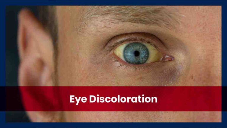 causes-and-types-of-eye-discoloration-affordable-health-coverage-plan